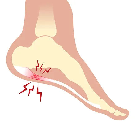 Plantar Fasciitis: 4 factors that contribute to the development