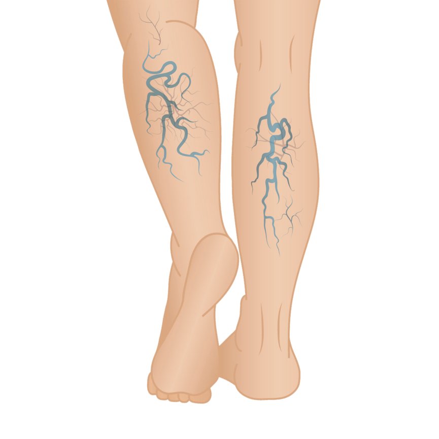 What Are Varicose Veins?