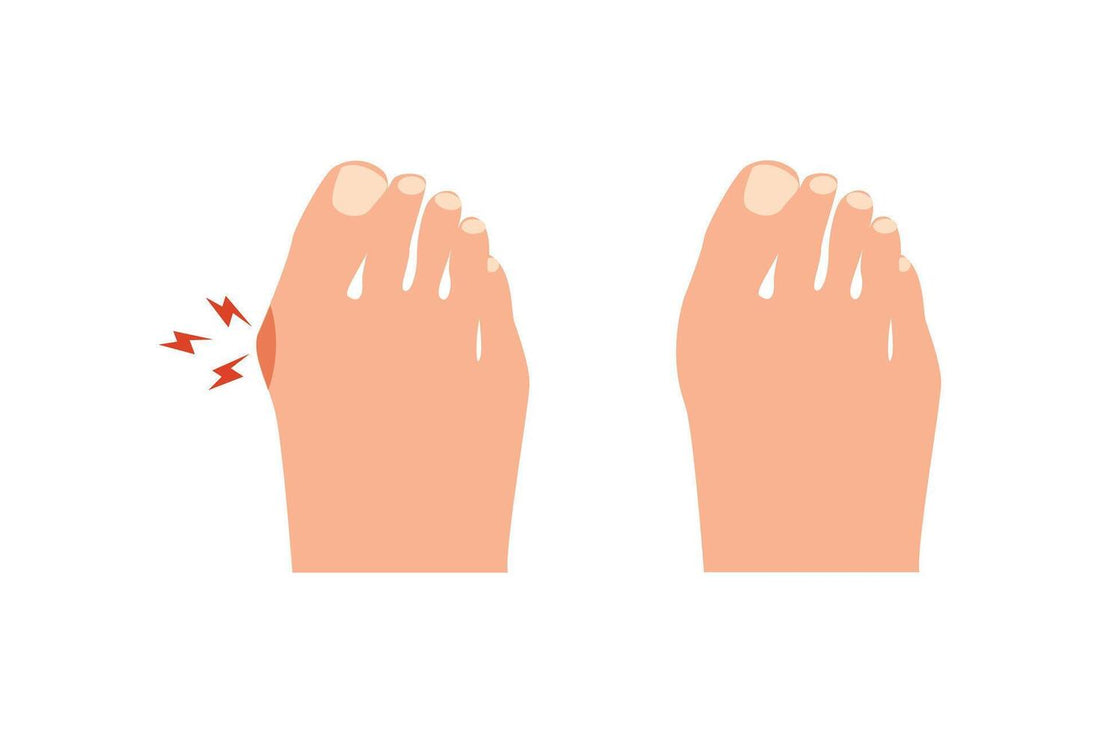 Bunions and Foot Health