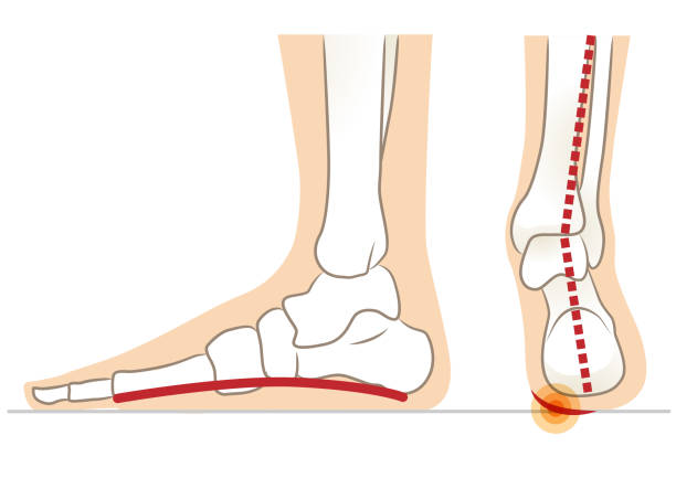 Flat Feet: 6 Essential Tips to Treat and Relieve Discomfort