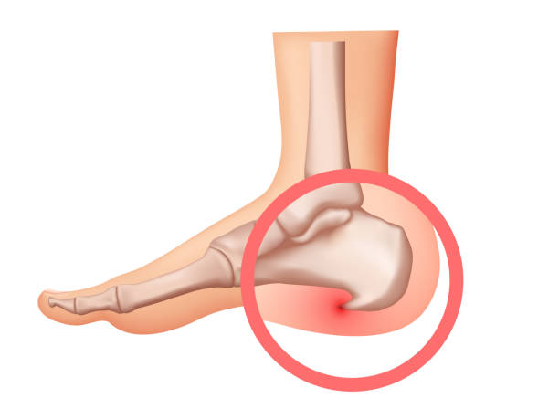 Living with Heel Spurs