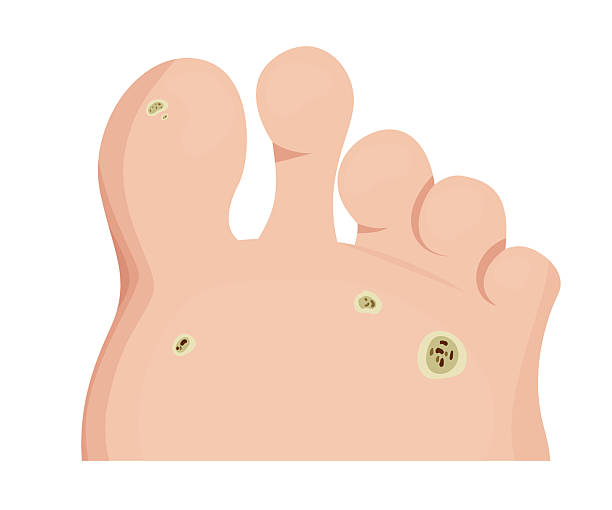 What Are Foot Corns?